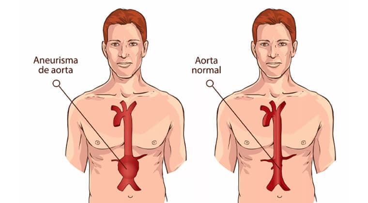 Aneurisma de aorta abdominal