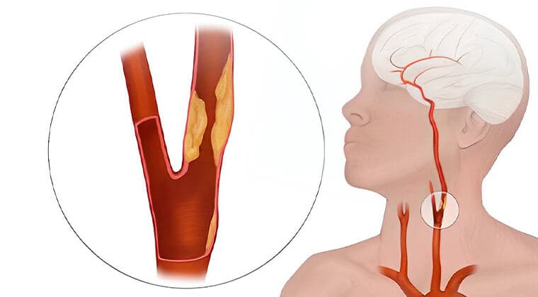 Enfermedad carotídea